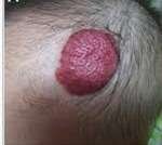 birth mark before