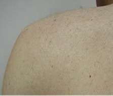 body laser hair removal after