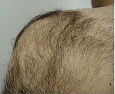 body laser hair removal
