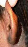 ear lobe keloid after