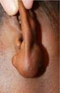 ear lobe keloid before