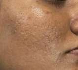 face scar after