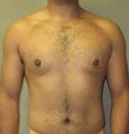 gynecomastia after