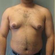 gynecomastia before