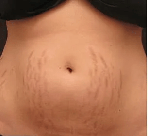 hybrid sterech mark treatment before