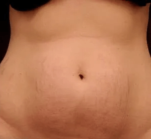 hybrid strech mark treatment after