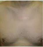 keloid aftrer