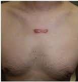 keloid before