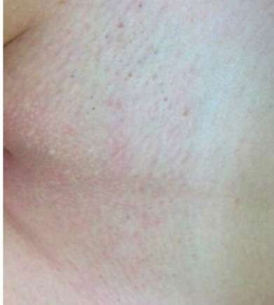 laser hair removal private parts after
