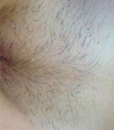 laser hair removal private parts before