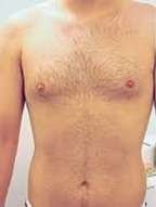 laser body hair remova before