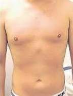 laser body hair removal after