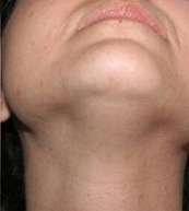 laser hair removal after