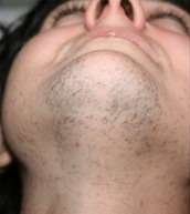 laser hair removal before