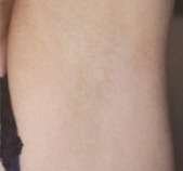 laser under arm hair removal aftert