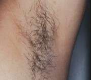 laser under arm hair removall before
