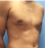 male breast surgery after