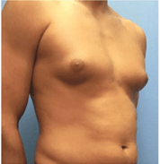 male breast surgery before
