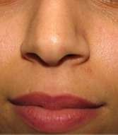 mole removal after