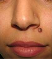 mole removal before