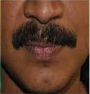 moustaque hair grafting after