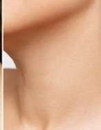 neck rejuvination after 1