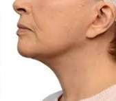 neck contouring after