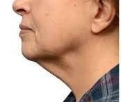 neck contouring before