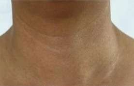 neck skin tages removal after