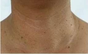 neck skin tags removal before