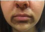 pigmentation arond mouth before.jpg