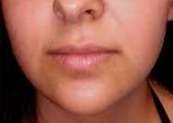 pigmentation around mouth after.jpg