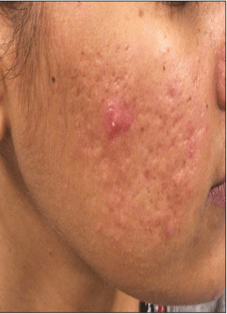 post acne scar after