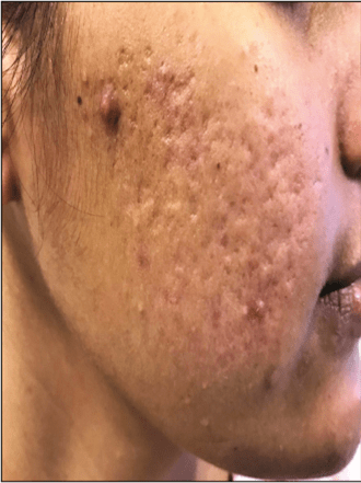 post acne scar before