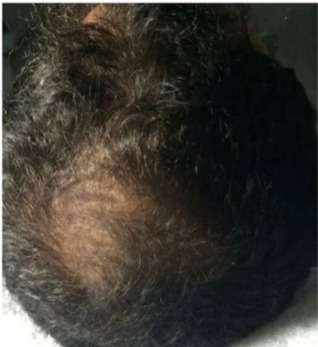 scalp rejuvination treatment after