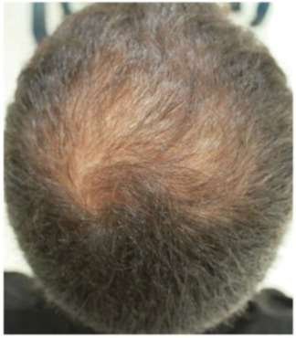 scalp rejuvination treatment before