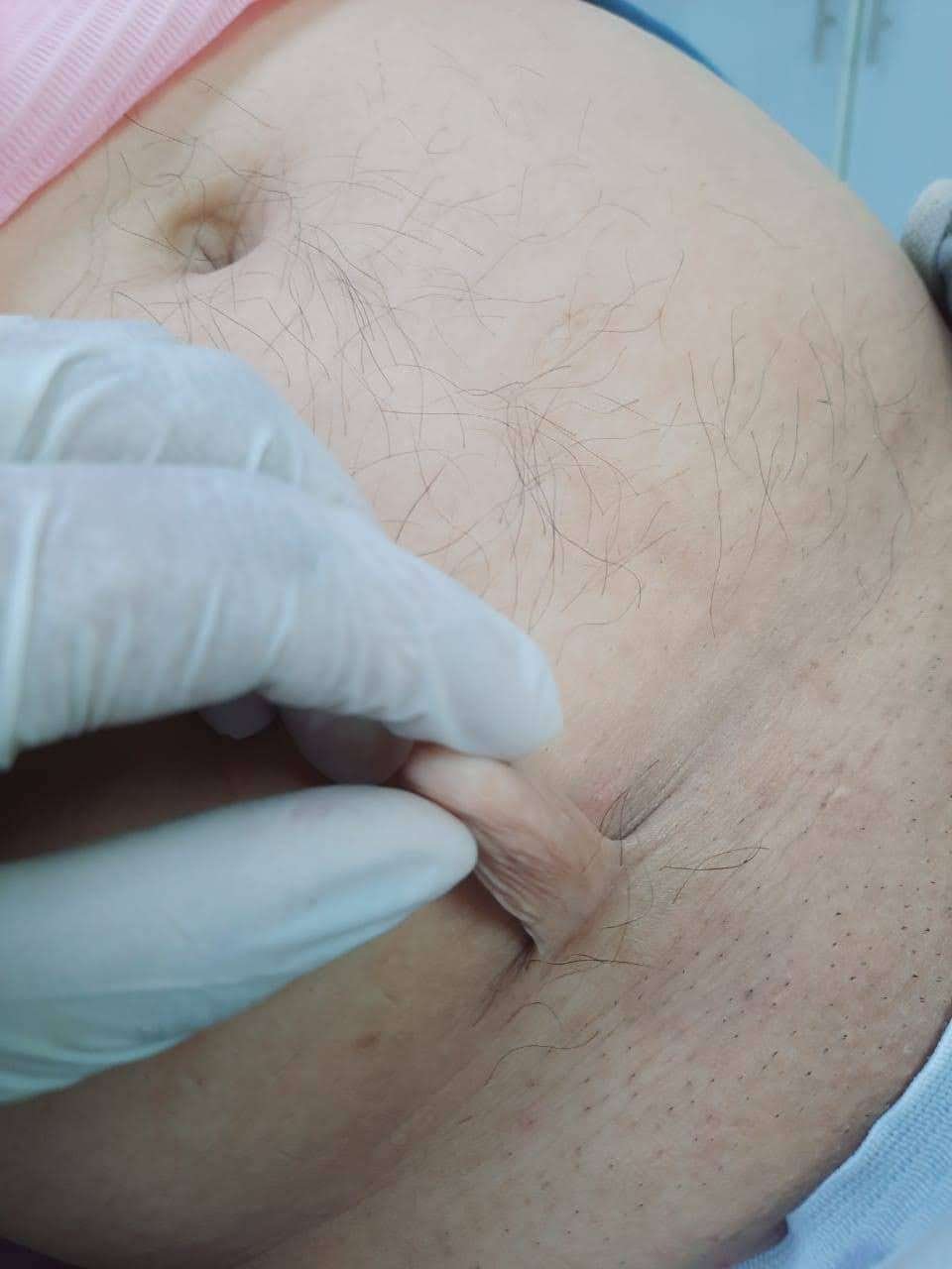 skin tag removal before