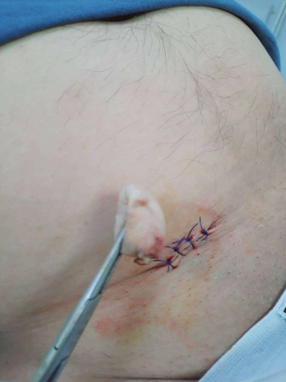 skin tag remvoval after