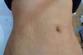 strech marks after