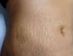 strech marks before