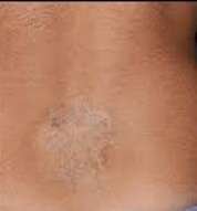 tatoo removal by laser after