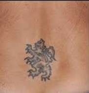 tatoo removal by laser before