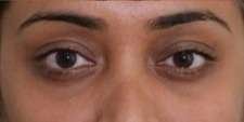 under eye pigmentation after