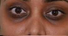 under eye pigmentation before