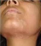vitiligo surgery after1
