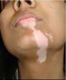 vitiligo surgery before1