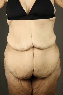 weight management 1 before