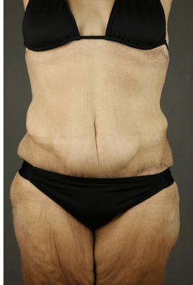 weight managent 1 after