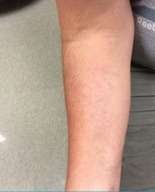 laser tatoo removal a