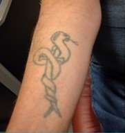laser tatoo removal b
